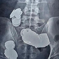 Moški s hudimi bolečinami v trebuhu poiskal zdravniško pomoč: zdravniki osupli nad odkritjem